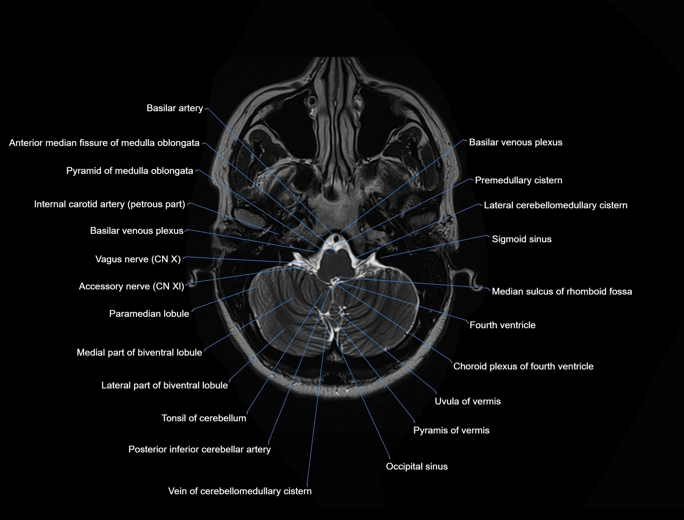 MRI Brain axial cross sectional radiology anatomy 3T image  -img-00001-00009.webp